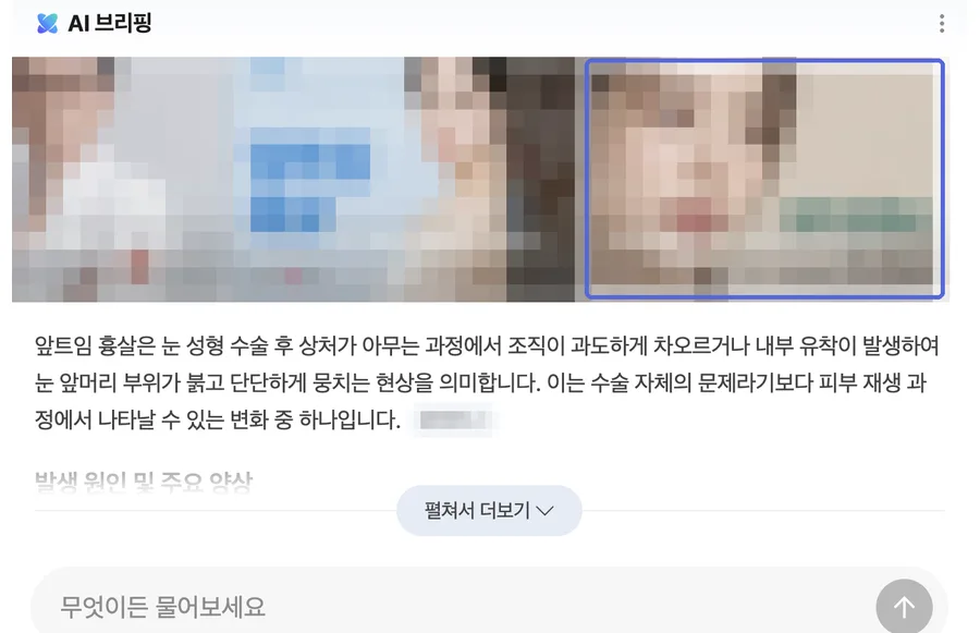 네이버 검색 결과 AI 브리핑 인용 화면, ○○흉살 · 월 검색량 400 키워드 (검색어와 병원 정보는 모자이크 처리)