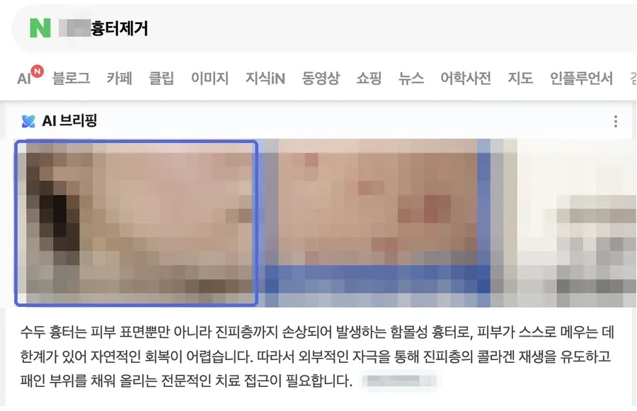 네이버 검색 결과 AI 브리핑 인용 화면, ○○흉터제거 · 월 검색량 130 키워드 (검색어와 병원 정보는 모자이크 처리)