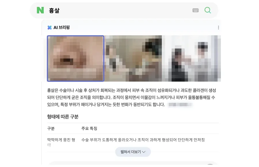 네이버 검색 결과 AI 브리핑 인용 화면, 흉살 · 월 검색량 1,180 키워드 (검색어와 병원 정보는 모자이크 처리)