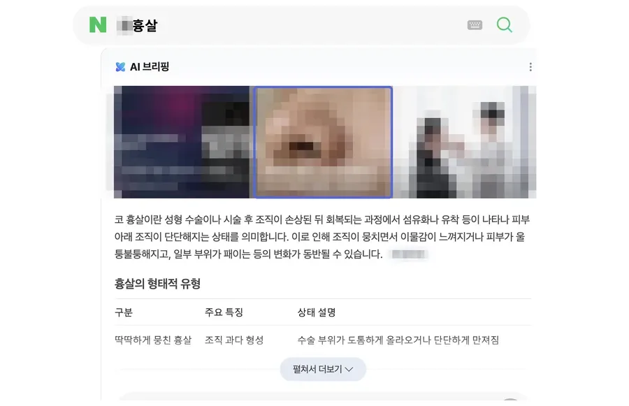 네이버 검색 결과 AI 브리핑 인용 화면, ○흉살 · 월 검색량 370 키워드 (검색어와 병원 정보는 모자이크 처리)